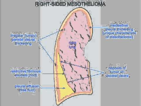 what causes squamous cell carcinoma of the head and neck