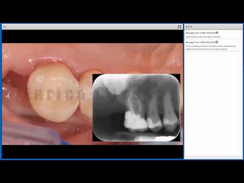 Video: Quali sono le cause del fallimento del sigillo apicale?