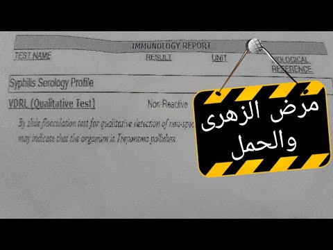مرض منقول جنسيا الزهرى 