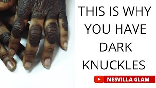 THIS IS WHY YOU HAVE DARK KNUCKLES.