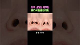 &quot;콧구멍 크기가 크고 비대칭이었어요&quot; | 30대 코성형 후기 #shorts