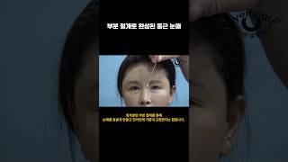 부분 절개로 완성된 둥근 눈매! 앞트임 실패, 쌍꺼풀 재수술로 극복
