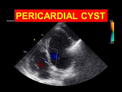 Pericardial Cyst - A rare echo finding