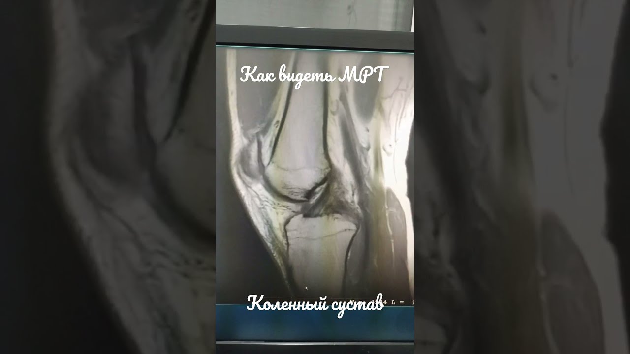 Мрт Коленного Сустава Ростов На Дону Цена