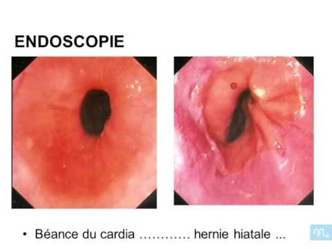 Vidéo: Hernie De L'œsophage - Symptômes, Traitement, Régime Alimentaire, Chirurgie, Causes, Signes