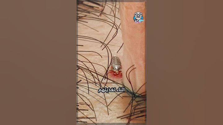كيف يعيش النمل في فروة رأسك؟ 😱