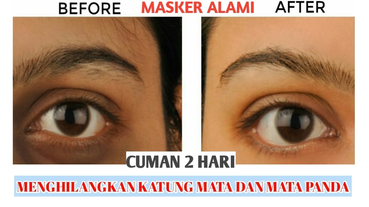 CARA MENGHILANGKAN KANTUNG MATA / MATA HITAM (PANDA