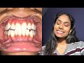 STRAIGHT TEETH IN 6 MONTHS? SMILE DIRECT CLUB - MY HONEST OPINION