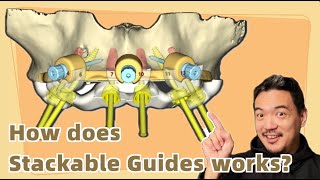 How does a stackable guide works?