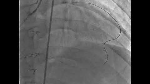 CTO of the LAD in a Young Adult After the Arterial Switch Operation - Angiogram 2