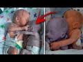 Mom puts the baby to the dying Twin and five minutes later a real Miracle happens