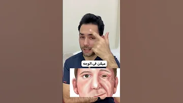 أعراض السكتة الدماغية Stroke 