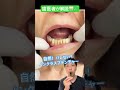 [バレない] 入れ歯はノンクラスプデンチャー #入れ歯 #ノンクラスプデンチャー #目立たない #前歯 #ﾐﾗｸﾙﾃﾞﾝﾁｬｰ #歯医者 #dentist