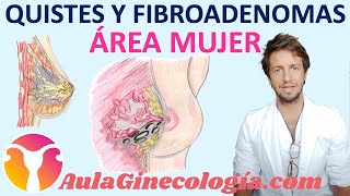 Quistes Y Fibroadenomas De Mama Qué Son Y Qué Repercusiones Tienen. - Ginecología Y Obstetricia -