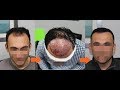 WATCH: Hair Transplant Patient's Journey from Day 0 to Month 6! | Feller & Bloxham | NY, NYC, NJ