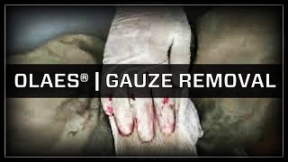 OLAES® Modular Bandage Series: Gauze Removal