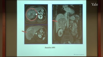 State-of-the-Art Transarterial Chemoembolization - 30 Years of TACE