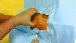 Knee joint injection for Arthritis
