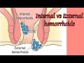 Internal &amp; External Hemorrhoids (Piles) I @DrAshishSachan