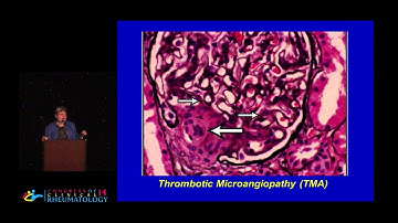 Michele Petri, M.D., M.P.H. - Antiphospholipid Antibody Syndrome Update