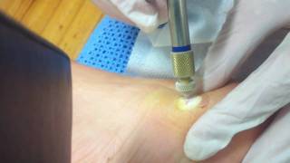 How To Kill Wart Kulugo Verruca Kutil Wrat How To Kill Wart Kulugo Verruca Kutil Wrat