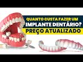 Quanto custa um IMPLANTE DENTÁRIO em 2022?