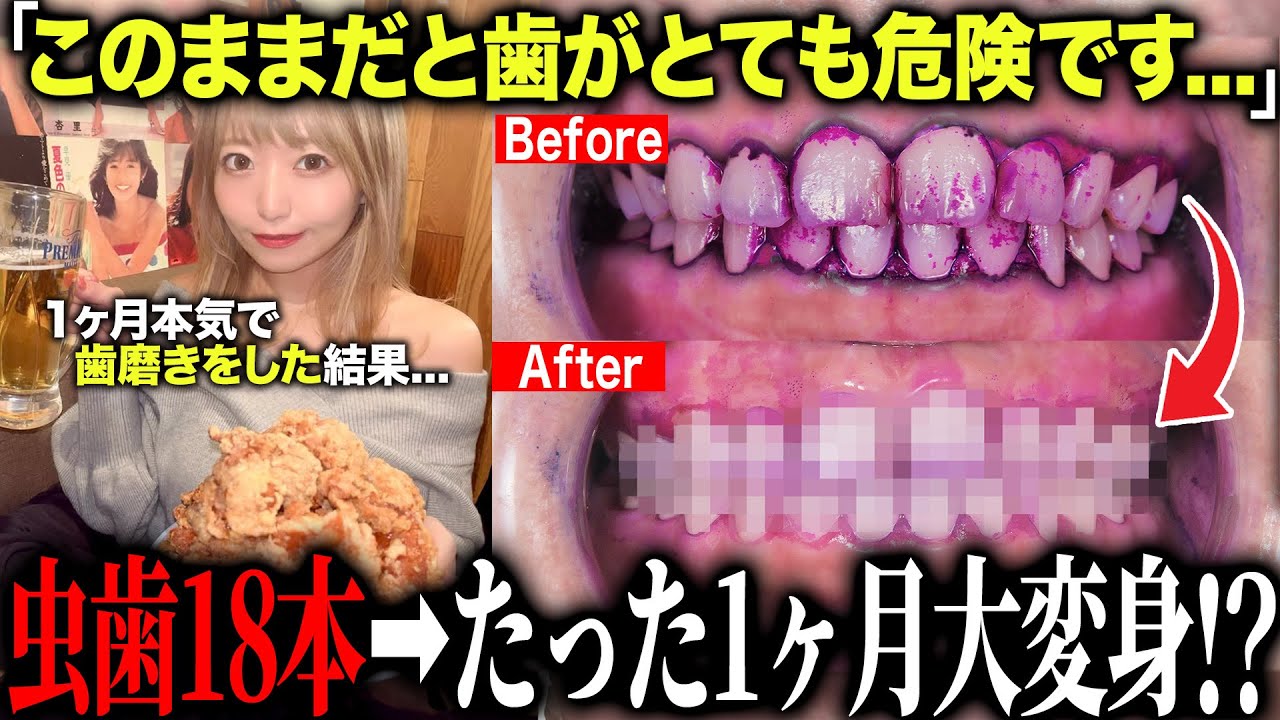 虫歯18本から始まったグラドルの1ヶ月歯磨き挑戦…驚きの結果に!?
