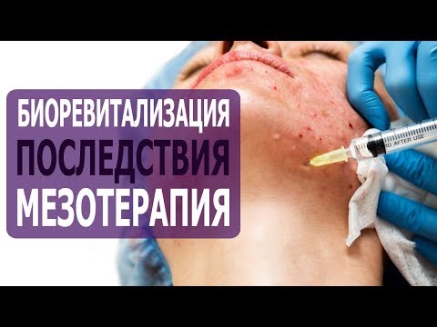 Видео: Мезотерапия на тялото за отслабване - отзиви, противопоказания