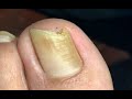 Remove sharp nail under nail corner