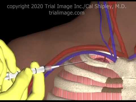 Subclavian Vein Access - Hypovolemic Patient - Animation by Cal Shipley, M.D.