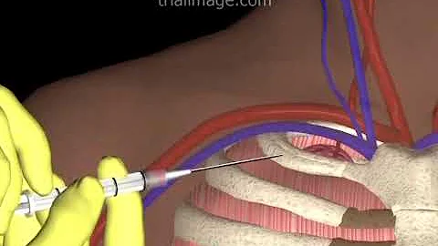 Subclavian Vein Access - Hypovolemic Patient - Animation by Cal Shipley, M.D.