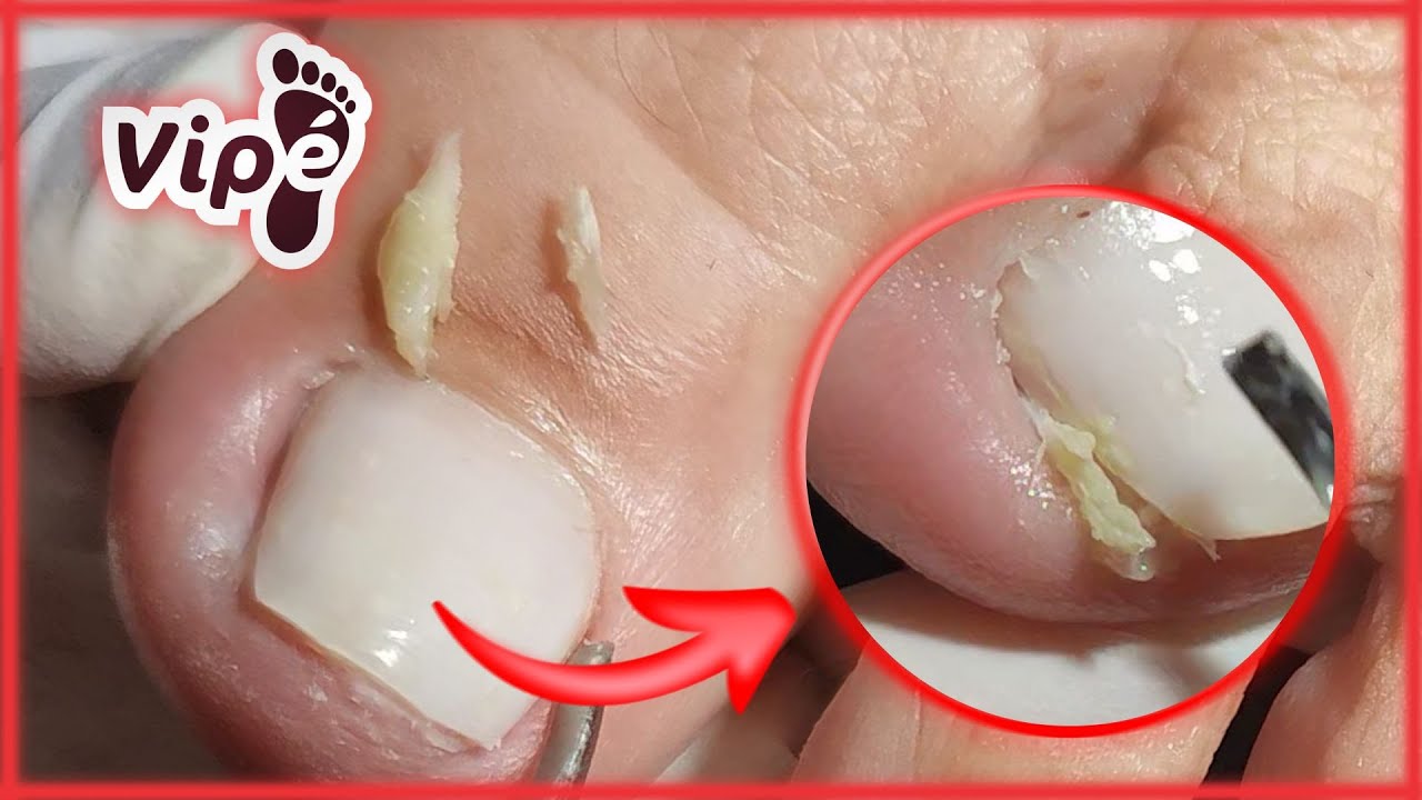 OVERGROWN INFECTED INGROWN TOENAIL REMOVAL YouTube