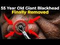 55 Year Old Giant Blackhead Finally Removed