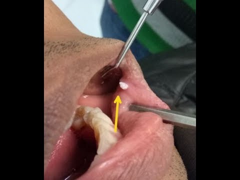 Video: Papillomas In The Mouth: Treatment, Symptoms, Causes