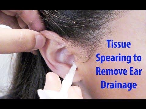 Video: Cum se scurge lichidul urechii (cu imagini)