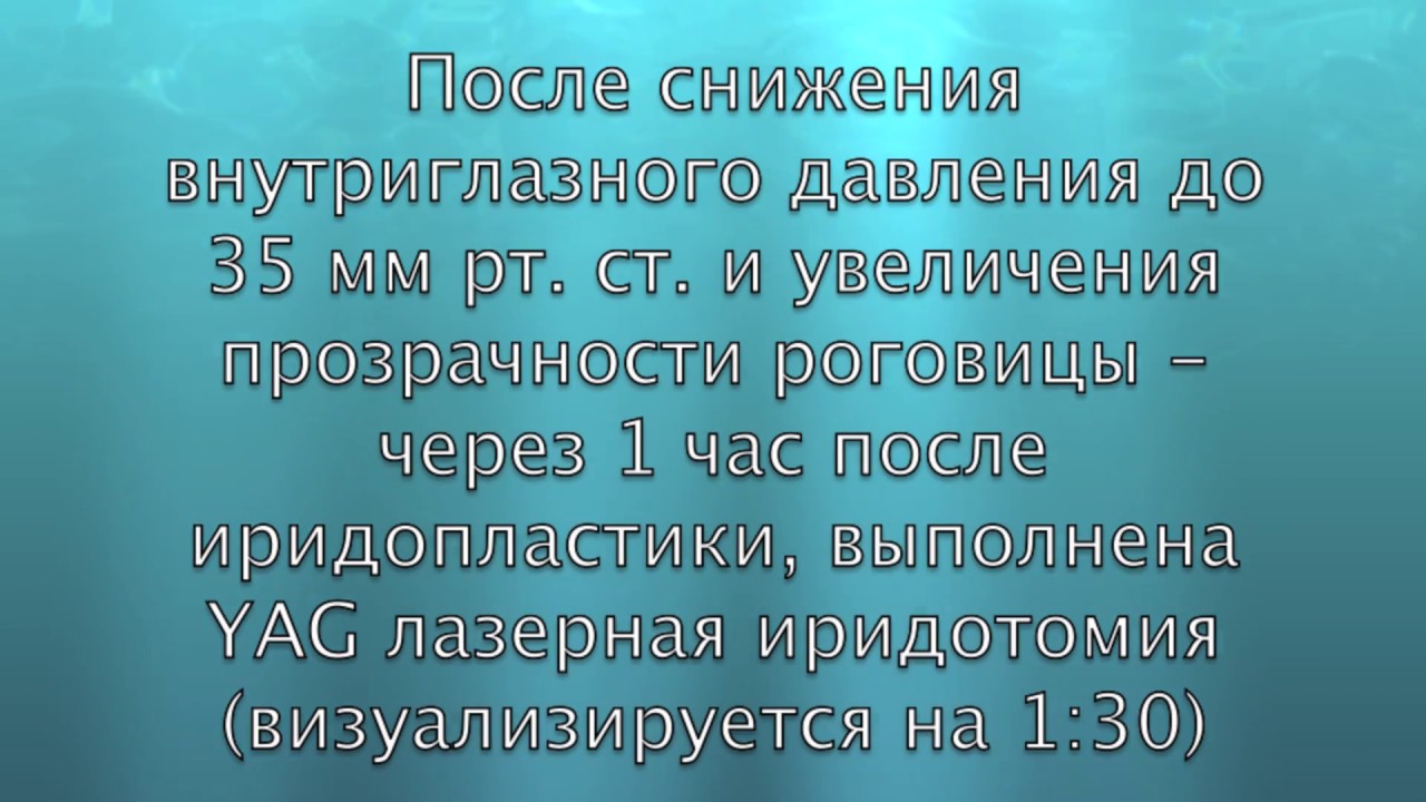 Купирование острого приступа глаукомы AcuteAngle Closure