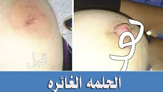 الدكتور ياسر العلي - عمليات تكبير و زراعة الثدي