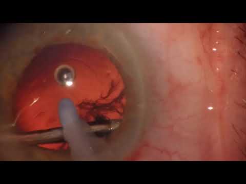 Dealing with sub incisional cortex