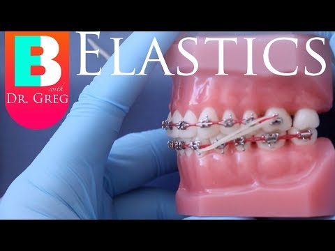 [BRACES EXPLAINED] Elastics / Rubber Bands