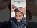 Secret of Good Hair Transplant Result Indore | Bhopal | Dr Sanjay Pancholi MD Dermatologist #viral