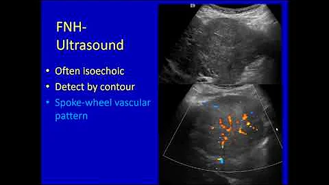 Liver Lesions by Deborah J  Rubens, MD   SD