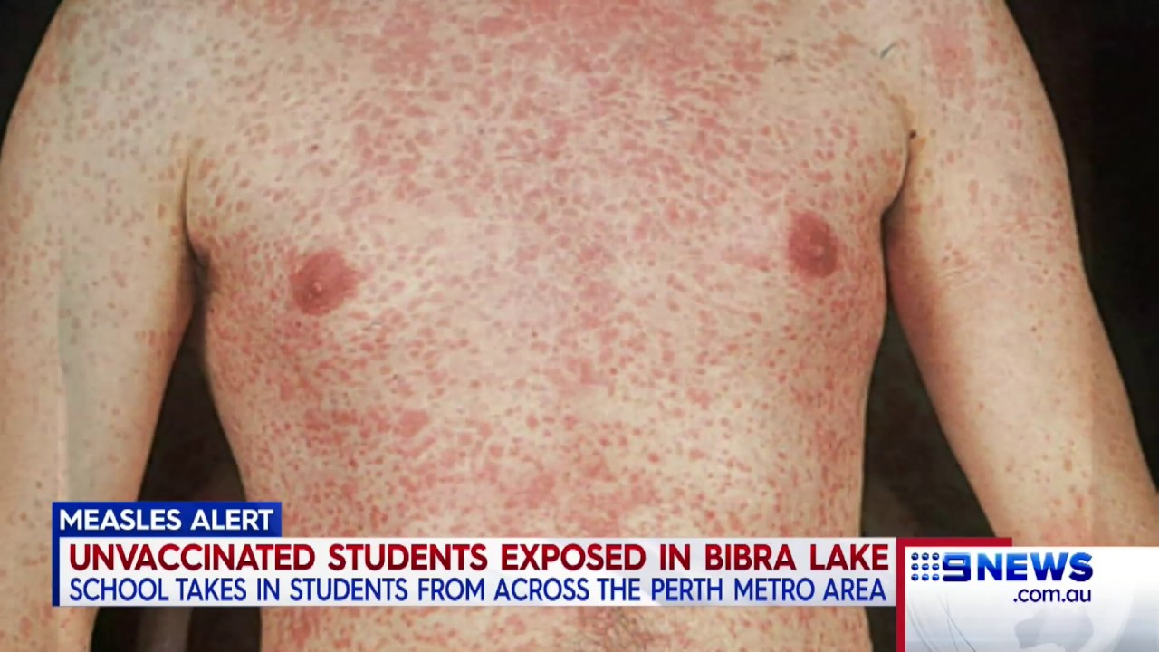 How is measles in an adult How is measles in an adult