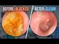 EXTREME IMPACTED EAR WAX - Thick Keratin Plug Removal - EP1235