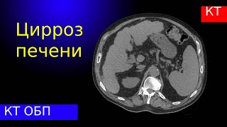 Лучевая диагностика цирроза печени