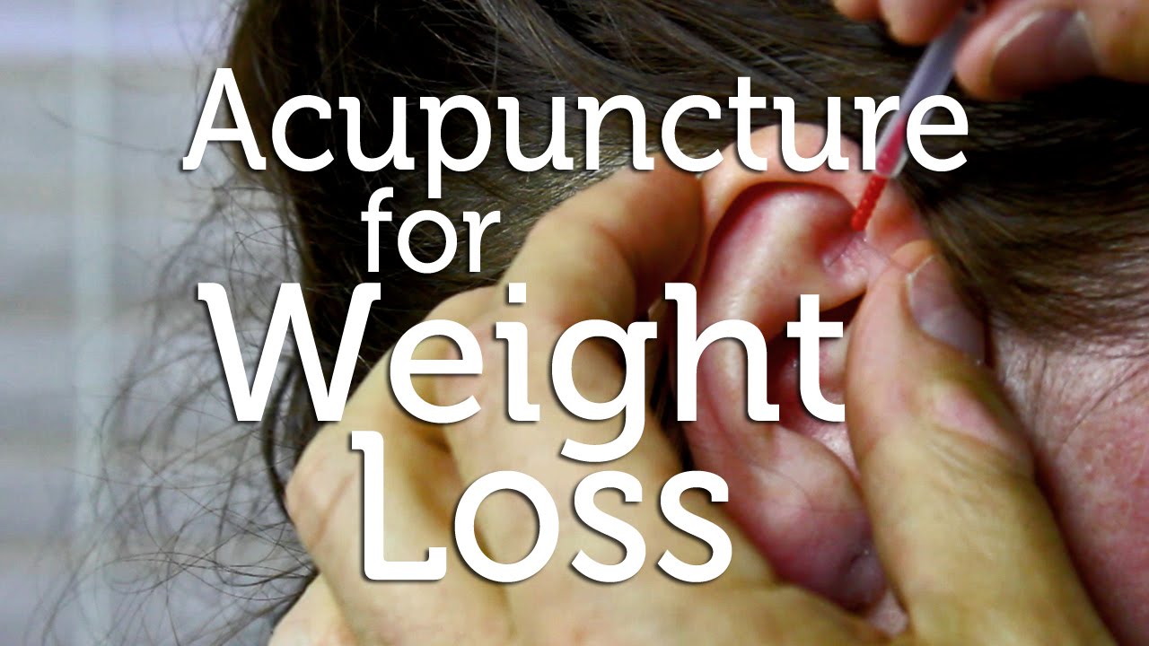 Acupuncture for Weight Loss