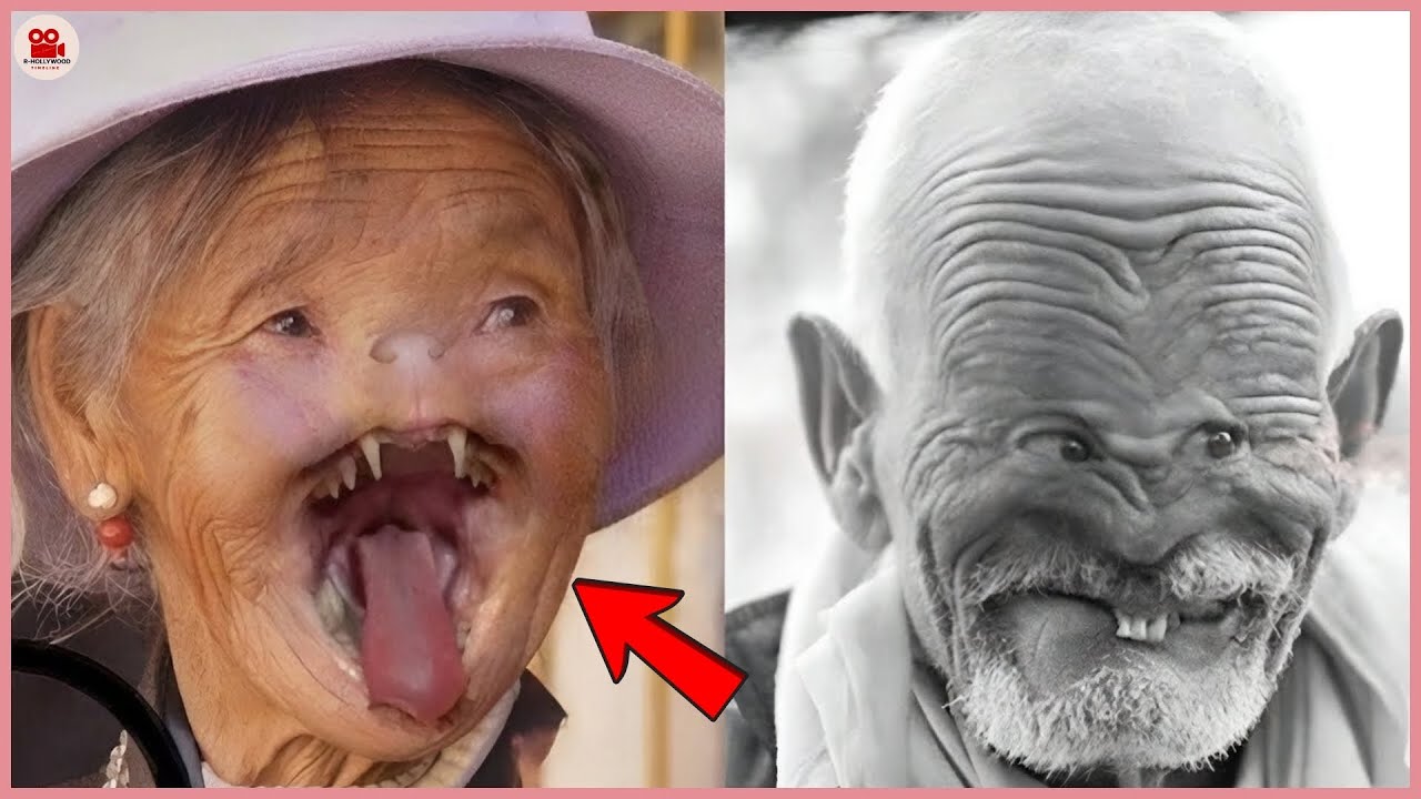 This Old Woman Had A Rare Facial Condition ! 15 Unusual People Who Shocked The World | Then and Now