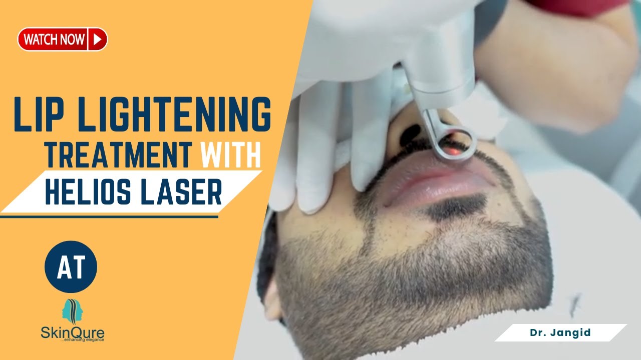 Lip lightening treatment with Helios Laser by Dr Jangid SkinQure YouTube