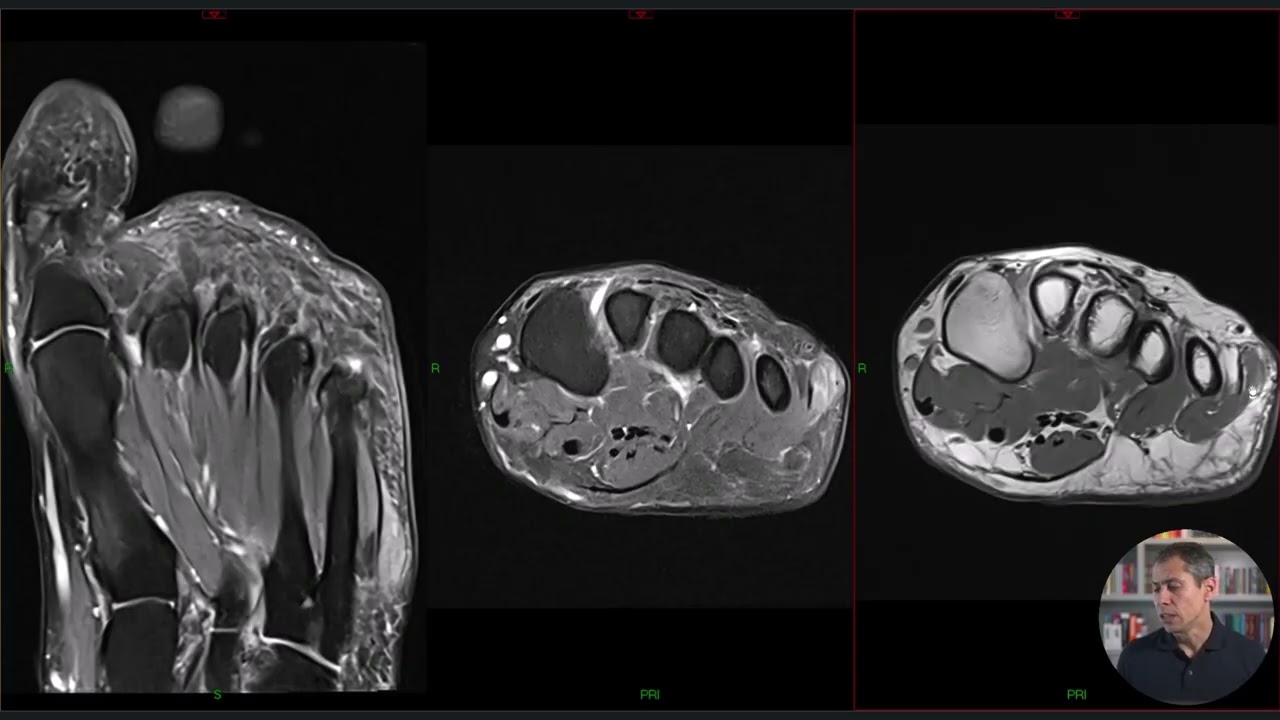 RM na Neuropatia de Baxter (achados no antepé)