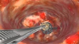 Animation: Scar Tissue Removal to Release TORP