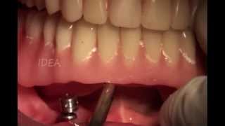 Implant supported complete denture.wmv